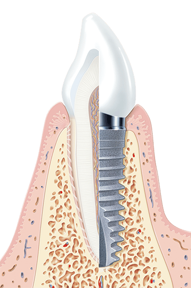 Implants, Thamesmead